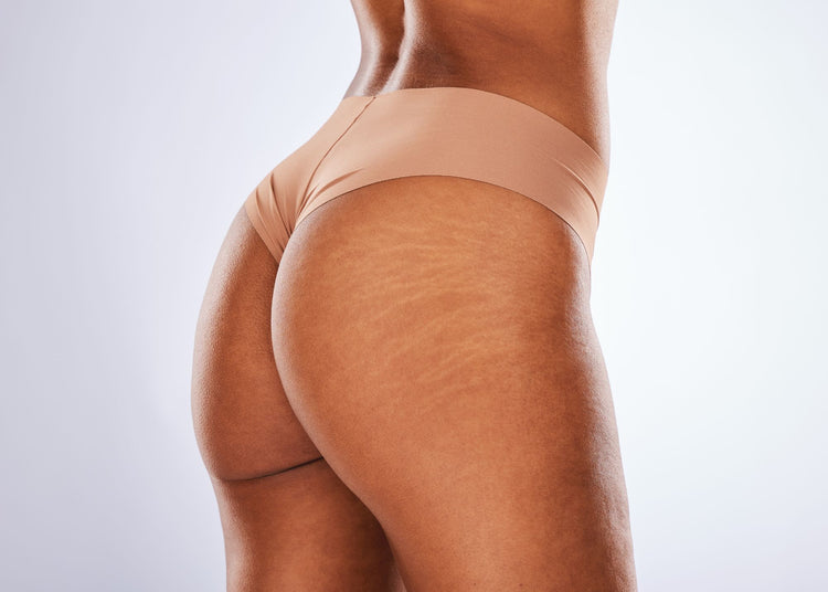 Stretch Marks