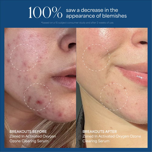 Zoned In Activated Oxygen Ozone Clearing Serum