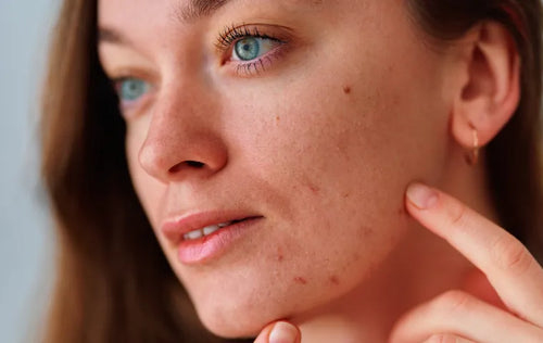 Damaged Skin Barrier and Acne: Understanding the Connection